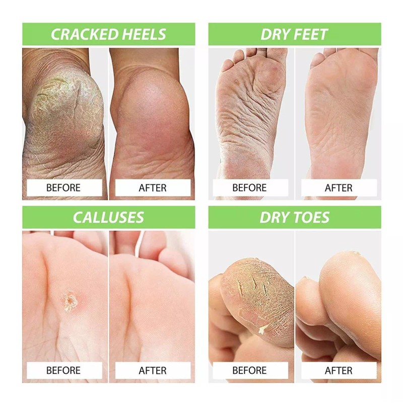 FOOT CURE Pie Cure Aceite Del Árbol Del Té Baño