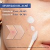 Dr.leo Acne Buster Loción Secante Con Ácido Salicílico
