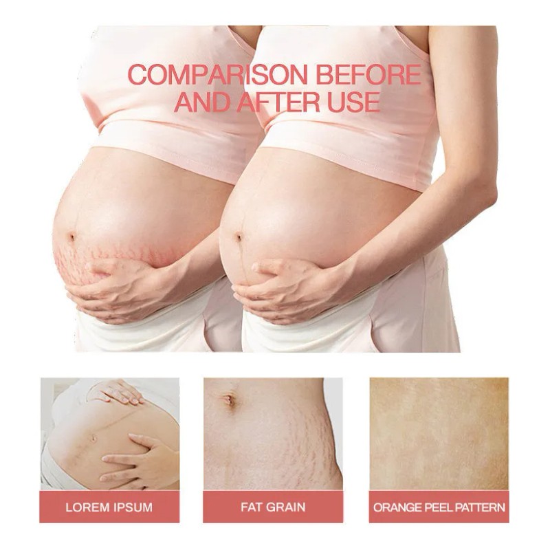 Aceite Estrías Stretchmark Cream Desali Mujeres