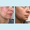 Glycolic Acid 50% Gel Peel - Enhanced with Retinol &