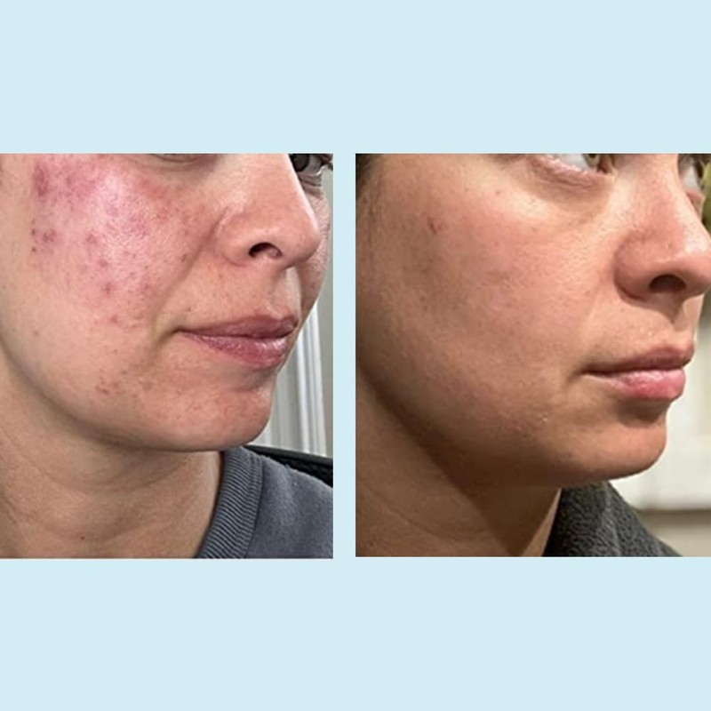 Glycolic Acid 50% Gel Peel - Enhanced with Retinol &