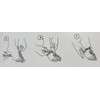 Russka Hallux Valgus Night Splint for Correction of Big Toe