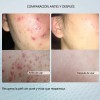 Crema Reparadora Facial 20g, Adecuada Para Piel Con Acné