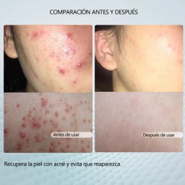 Crema Reparadora Facial 20g, Adecuada Para Piel Con Acné