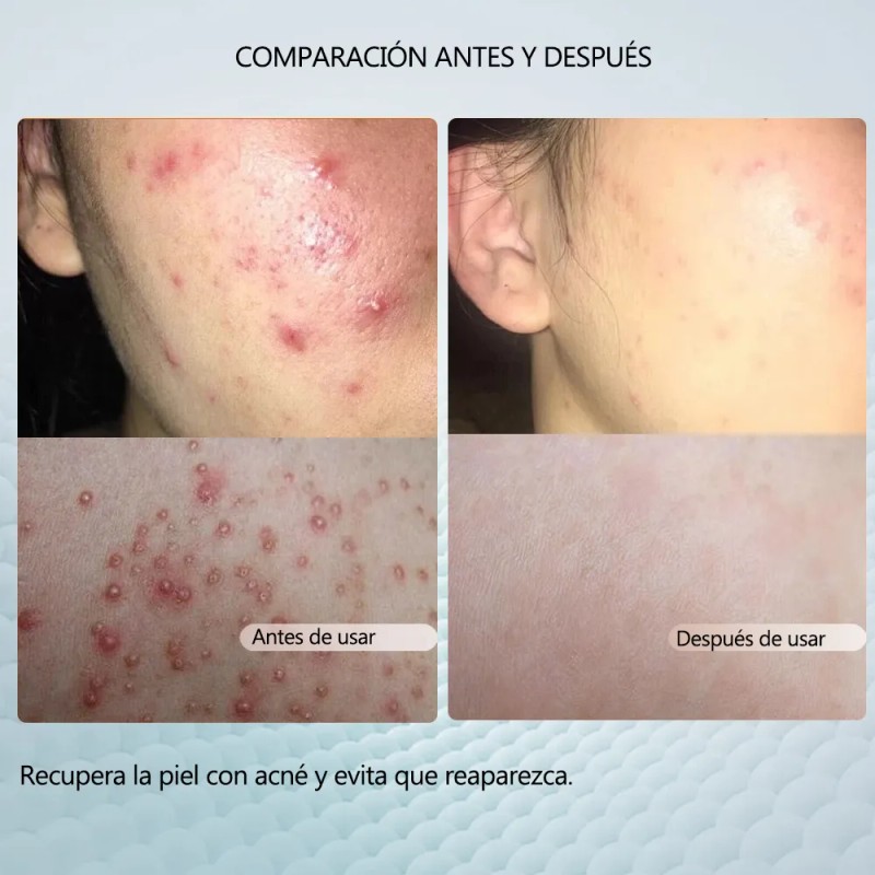 Crema Reparadora Facial 20g, Adecuada Para Piel Con Acné