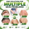 Tea Tree Oil Cream for Fungal-Prone Skin – Suitable for