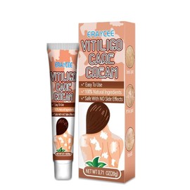 Vitiligo Cream, Natural Effective Vitiligo Treatment for Reduce White Spots and Improve Skin Pigmentation