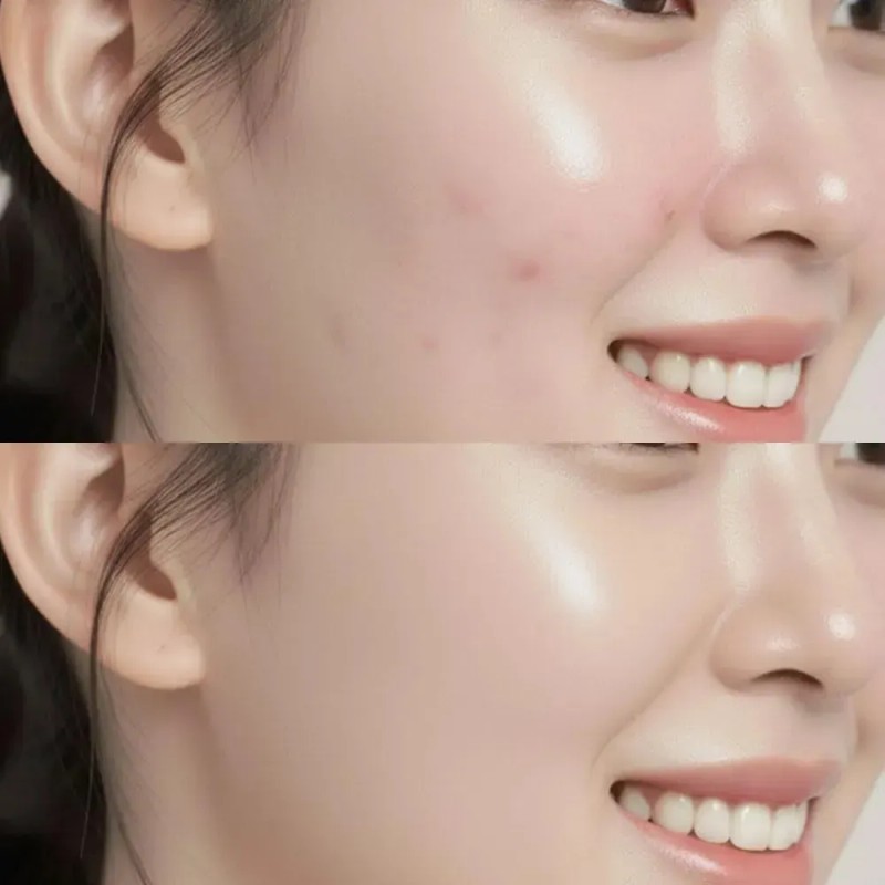 Tratamiento De Melasma Para Crema Facial