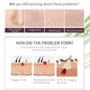 AHA 30% + BHA 2% Peeling Solution, Chemical Peel for