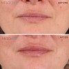 Mesolyft Neck & Lip Plumper Combo with Roller to Instantly