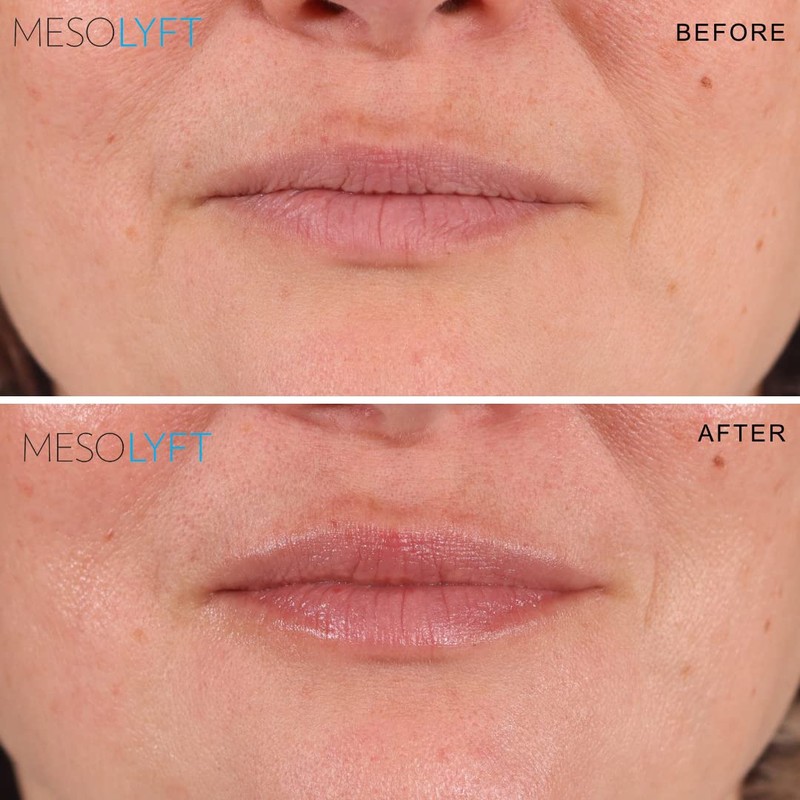 Mesolyft Neck & Lip Plumper Combo with Roller to Instantly