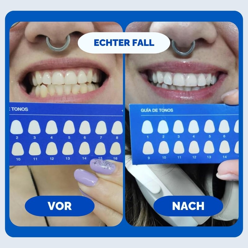 Professional Sensitive Teeth Whitening Strips - 28 Strips without Peroxide