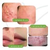 Serum Facial Tratamiento Acné Acnimed Secante Rápido Marcas