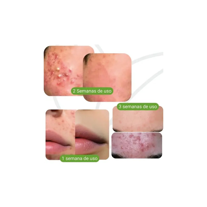 Serum Facial Tratamiento Acné Acnimed Secante Rápido Marcas