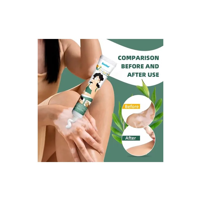 3 Cremas Vitiligo Tratamiento Profesional Sumifun