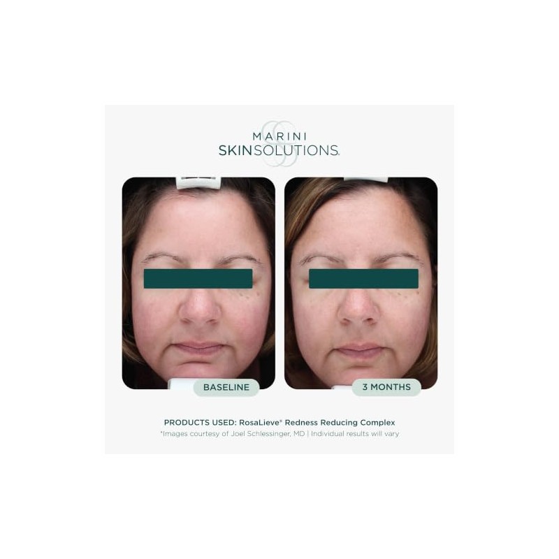 Marini SkinSolutions Rosalieve Redness Reducing Complex - Hidratante Facial con