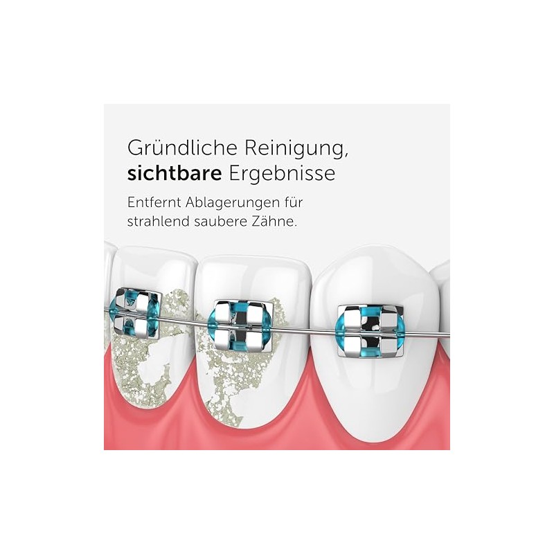 Wondersmile Periodontal Nozzle - Replacement Nozzles for Waterflow Oral Irrigator