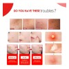 🔥 240pzs mascarillas parches para el acne espinillas granos Vitaminas