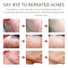 Crema Facial Para Eliminar El Acné, Ingredientes Naturales E