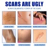 Professional Scar Removal Gel- Scarremoval treatment for keloids, C-sectionS, surgeries,