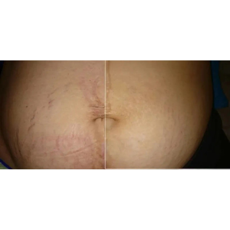 20skin Gel Para Estrías 50ml Para Todo Tipo De Estrias
