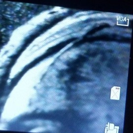 2024 p Dr. Mary Edwards Walker quarter reverse skull die crack- obverse die chip