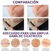 Cinta de silicona para cicatrices, (rollo de 4cm x 1.5