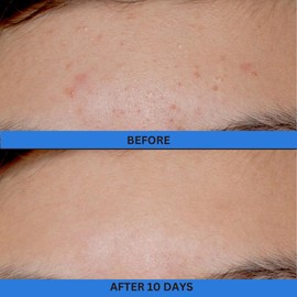 10% Glycolic Treatment Tonic Exfoliating Toner for Face and Body, Alcohol Free, Combats Acne and Hyperpigmentation, Rough Skin, All Skin Types Including Sensitive