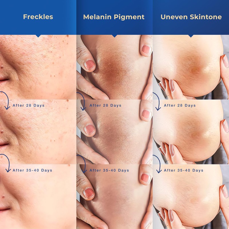 Dark Spot Corrector for Face and Body: For Age Spots,