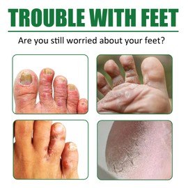 Mizonil Cream,Foot Care Cream Fußpflegesalbe Befeuchtet die Haut Nagel- und Fußpflegecreme 50 ml (2Stück)