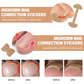 Ingrown Toenails Set, Toenail Correction Patch, Nail Plaster, Ingrown Toenails, Strips, Nail Fungus Plaster, with 1 x Nail Insert Tool, Pack of 501