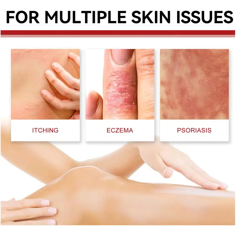 Pomada Herbal Antibacterial para Cuidado de la Piel Sensible Irritación,