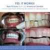 Crystal Clear Teeth Whitening Kit de Gel Blanqueador de Dientes