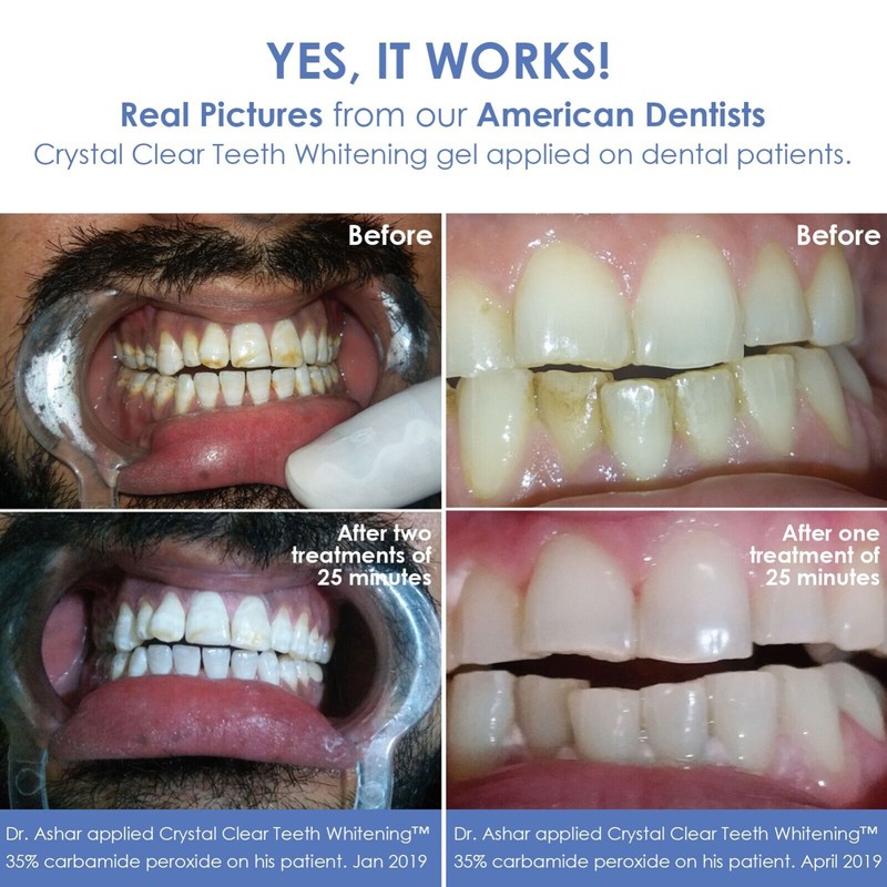 Crystal Clear Teeth Whitening Kit de Gel Blanqueador de Dientes
