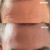 Wrinkles Schminkles Men's Pro Forehead Wrinkle Patches - 2 Patches