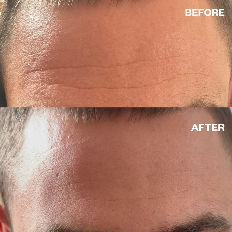 Wrinkles Schminkles Men's Pro Forehead Wrinkle Patches - 2 Patches