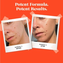 No B.S. (No Bad Stuff) Acne Spot Treatment, 2% Salicylic Acid Cream For Face, Chamomile Flower, Aloe vera & Vitamin E, Day & Night Cream, 0.5 FL Oz