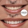 MOON LED Teeth Whitening Kit - Gentle Teeth Whitener Device,