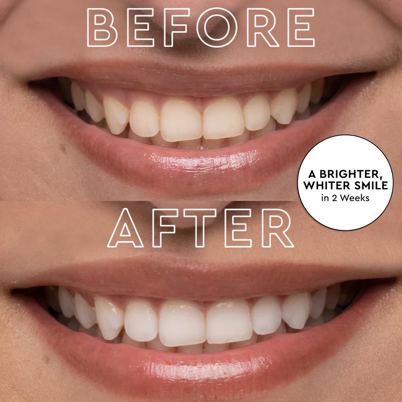 MOON LED Teeth Whitening Kit - Gentle Teeth Whitener Device,
