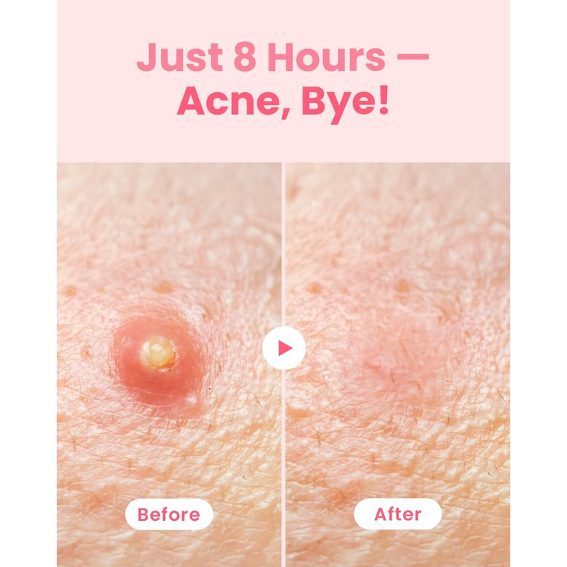 GLAM UP Hydrocolloid Blemish Pimple Zit Patches - Invisible Ultra