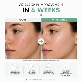 MIA KLINIKA Azelaic Acid Serum for Blemish-Prone Skin – With Niacinamide, Zinc & Tea Tree – Helps Reduce Redness & Imperfections – Lightweight Formula – 30ml