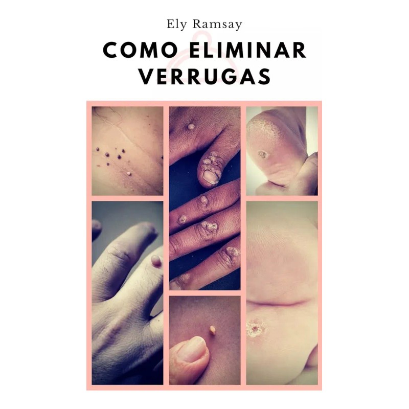 Lapiz De Plasma Electrico Remueve Verrugas Granos Vph Unisex