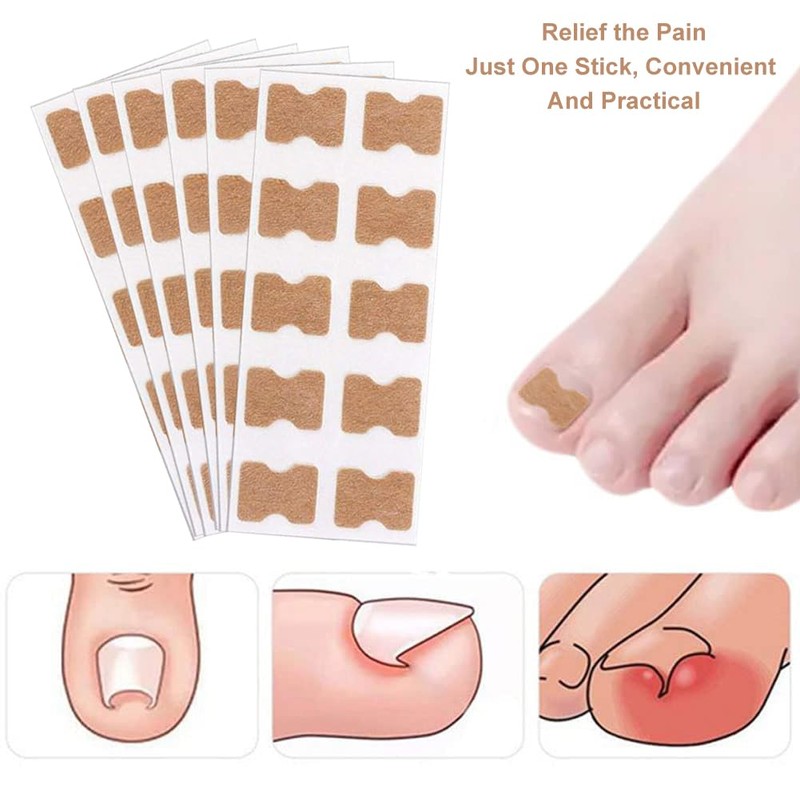 Ingrown Toenails Set, Toenail Correction, Toenail Patch, Toenail Correction Patch,