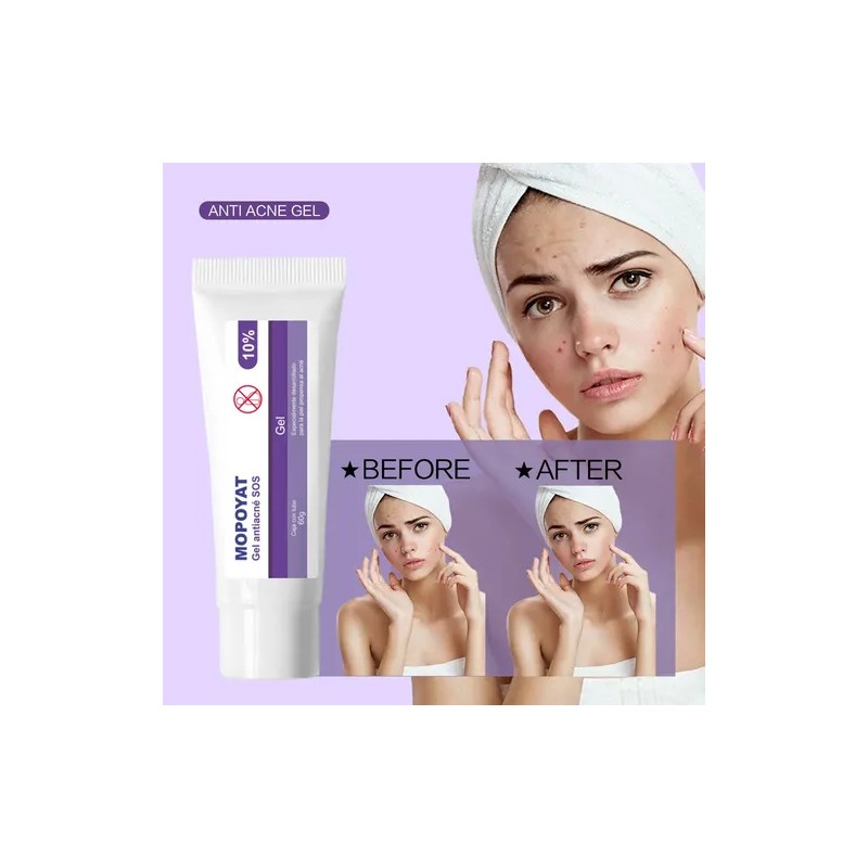 3pcs Gel Peróxido Benzoilo 10% Elimina Acné Puntos Negros