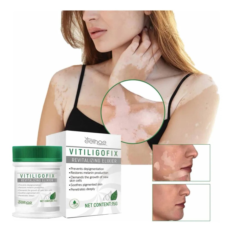 Crema Uv White For Vitíligo, Aceite De Vitíligo Localizado