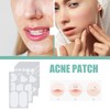 396Pcs Blemish Patches Facial Pimple Zit Spot Stickers Mild Non