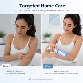 311nm Narrowband UVB Phototherapy Lamp for Targeted Use – Handheld Light Device for Clinician-Guided Home or Clinic Routines