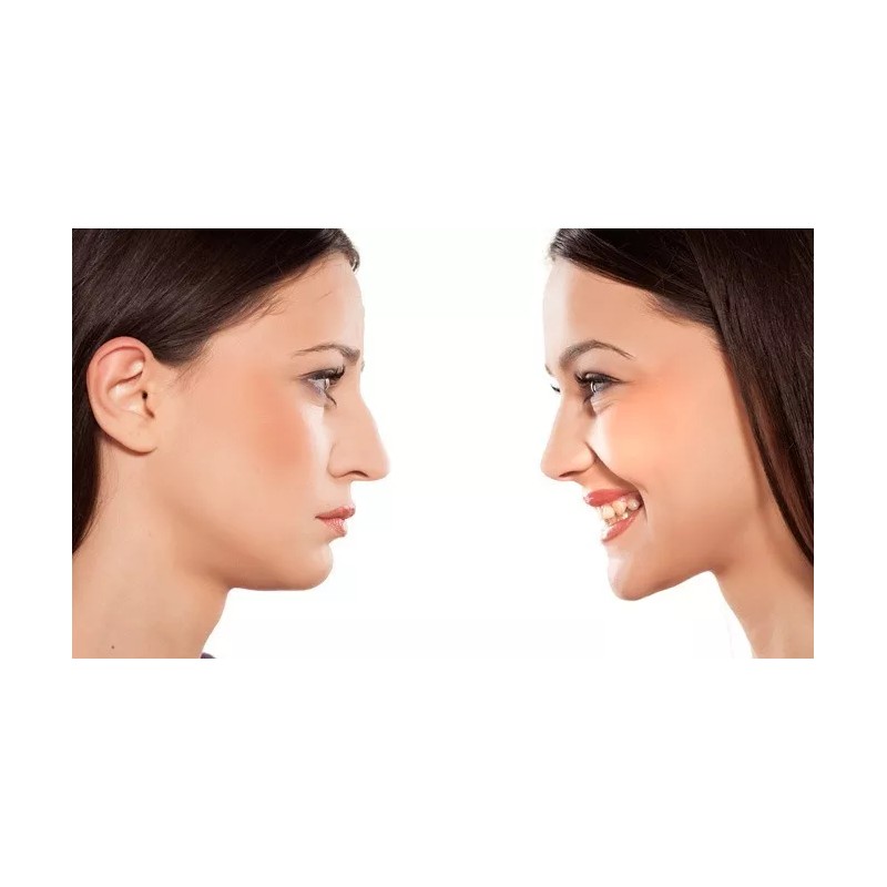 3D Rhinoplasty Respingadores Nasales 7 Pzs Corrector Levanta Nariz Estiliza