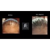 Solución Anticaida Para Hombre Con Cabello Con Caspa