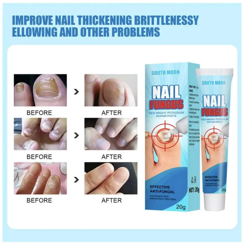 Tt/ Crema Fungicida Para Hongos En Uñas Y Piel De